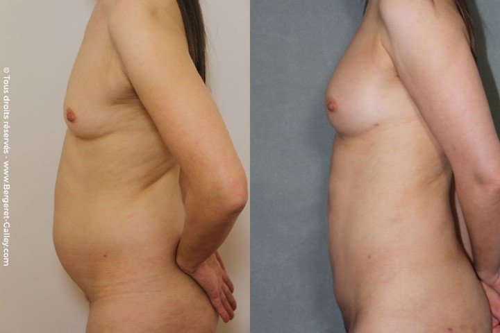 Lipofilling des seins