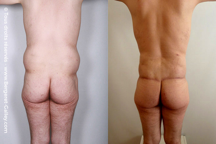 Before/After Bodylift for man