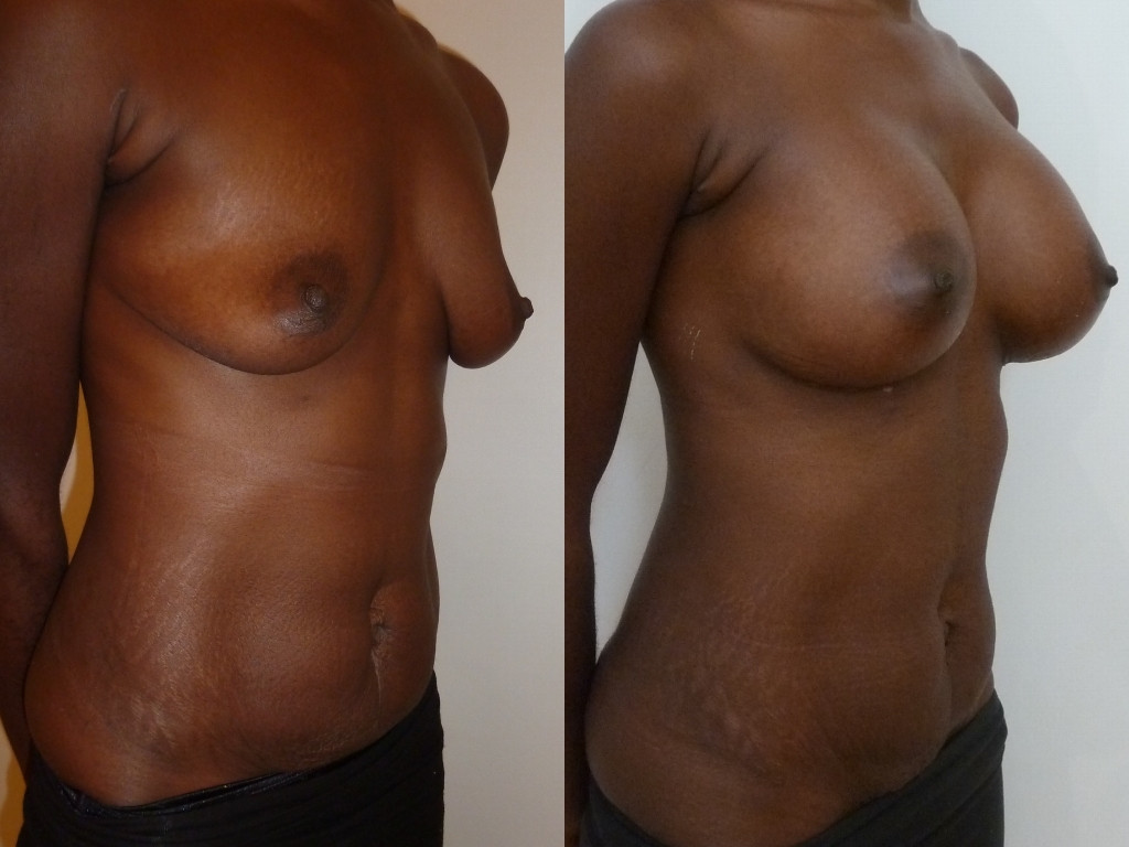 Avant/après chirurgie d’augmentation mammaire par prothèses