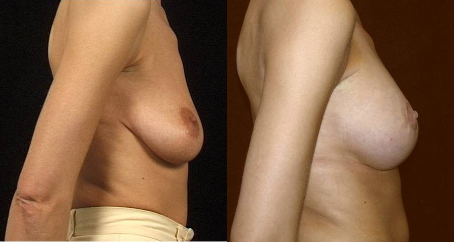 Breast augmentation with simultaneous lifting