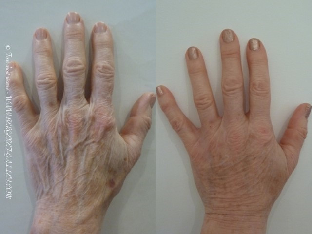 Résultat du lipofilling des mains