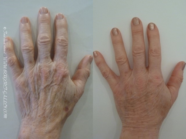 Résult of lipofilling hands