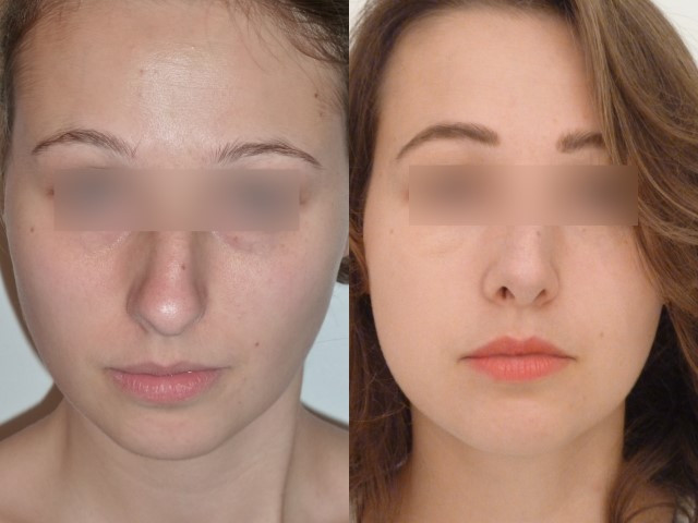 Résultat avant/après rhinoplastie