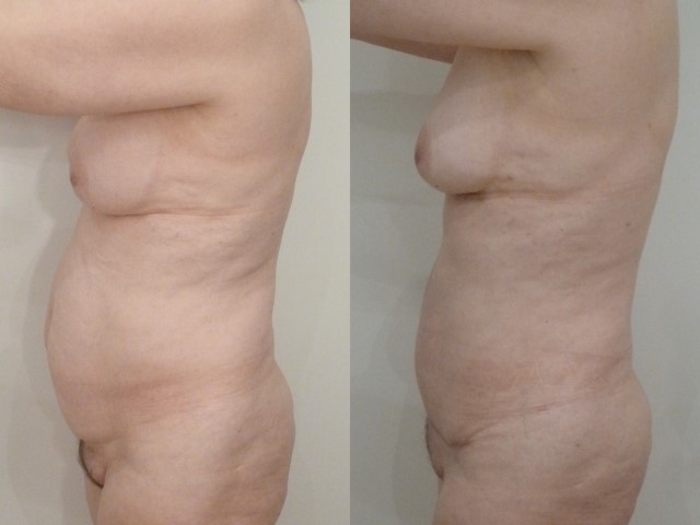 abdominoplastie