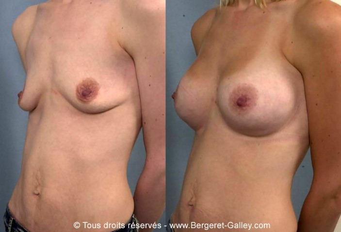Photo avant/après augmentation mammaire avec des prothèses 260ml
