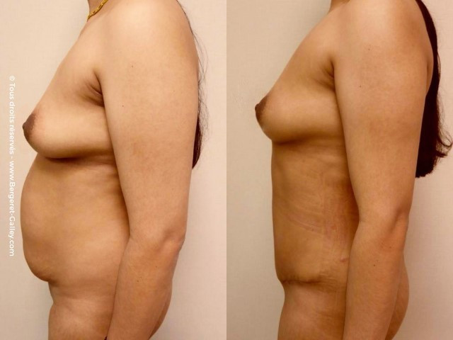 Abdominoplastie de profil