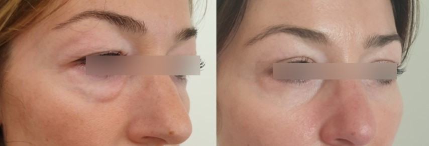 Résultat d'une blépharoplastie