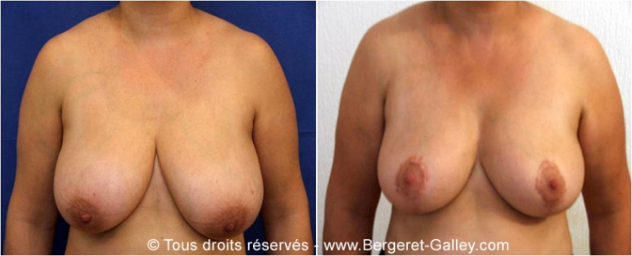 Mammary reduction