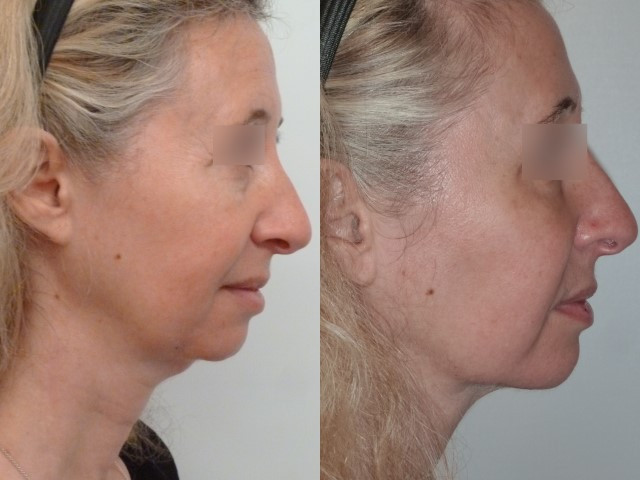 Lipofilling du visage