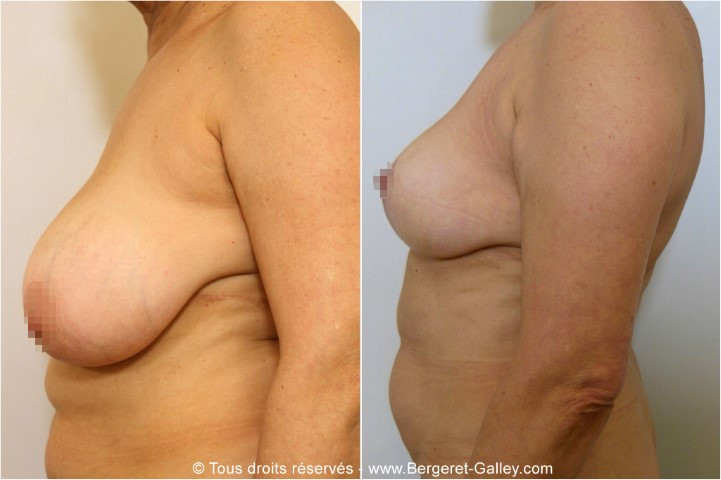 Breast reduction