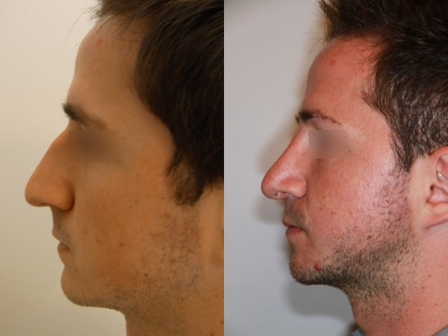 Résultat avant/après rhinoplastie