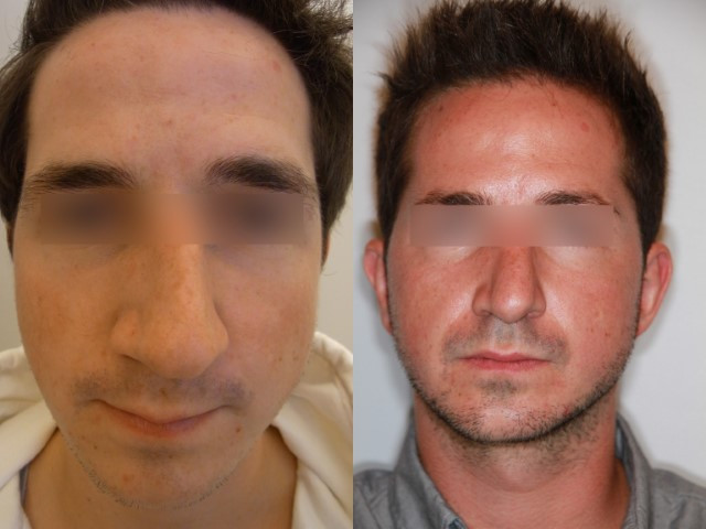 Résultat avant/après rhinoplastie