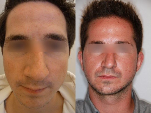 Before/After Rhinoplasty Paris
