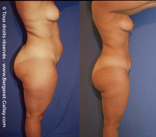 Thighs Liposuction and   buttocks liposuction