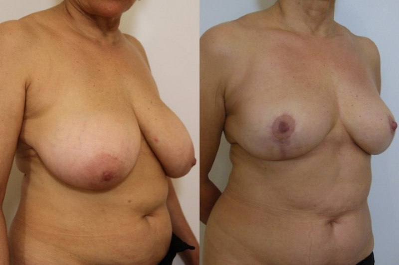 Breast reduction