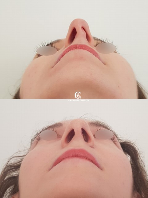 Résultat avant/après rhinoplastie