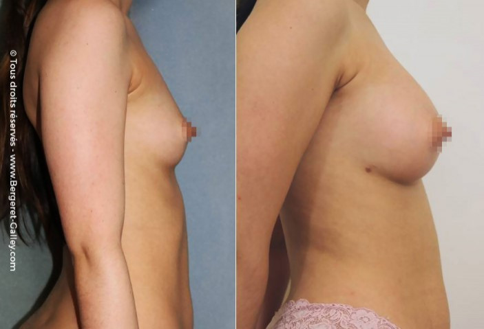 Lipofilling seins