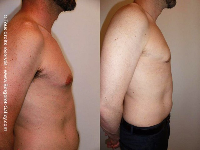 Lipoaspiration de Gynécomastie