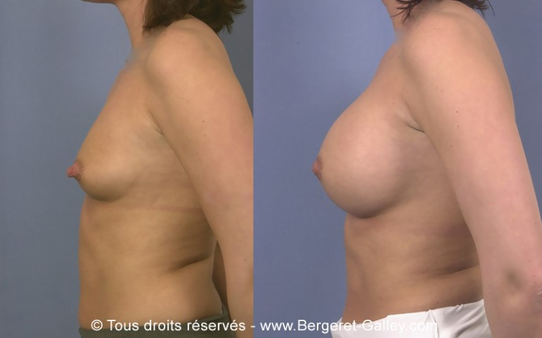 Résultat augmentation mammaire avec des prothèses 350ml