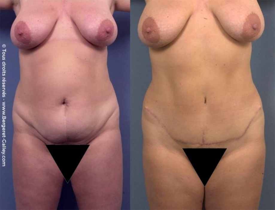 Abdominoplasty berfore/after