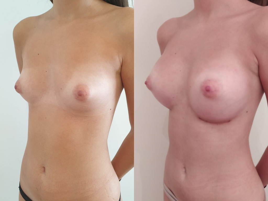 Tuberous breasts before after surgery