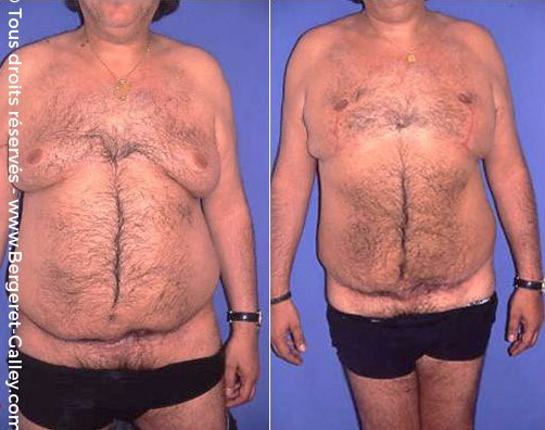 Lipoaspiration de Gynécomastie