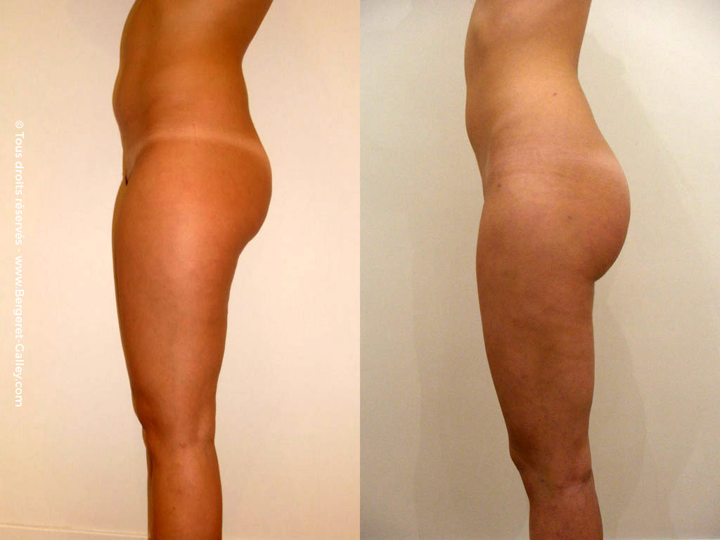 Thighs Liposuction and the buttocks