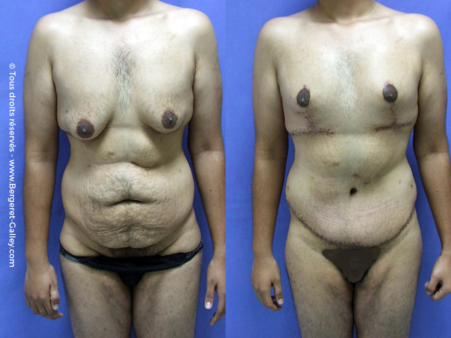 Liposuction of gynecomastia