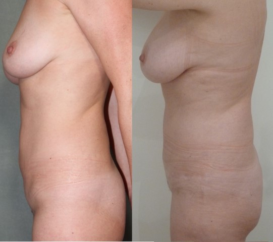 abdominoplastie