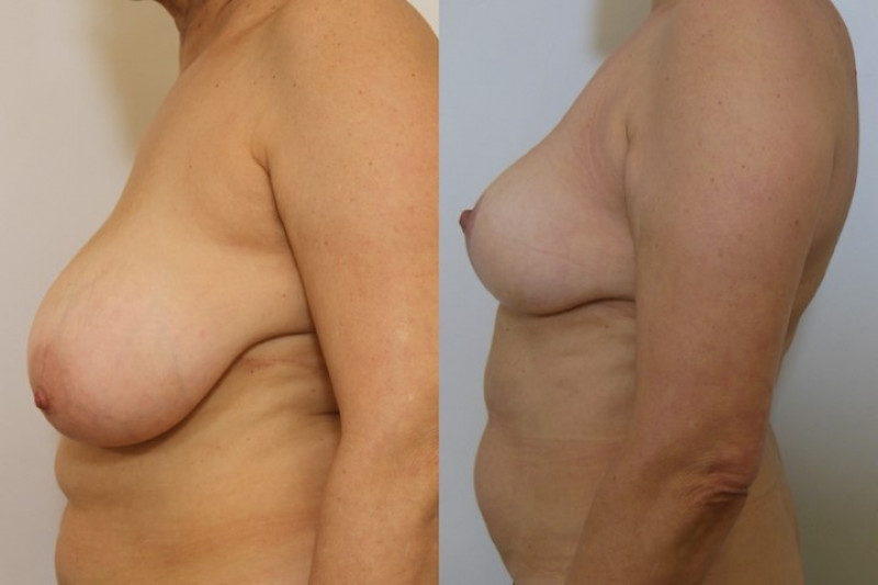 Breast reduction