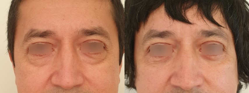 Résultat d'une blépharoplastie