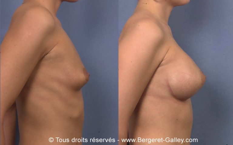 Résultat augmentation mammaire avec des prothèses 350ml de côté