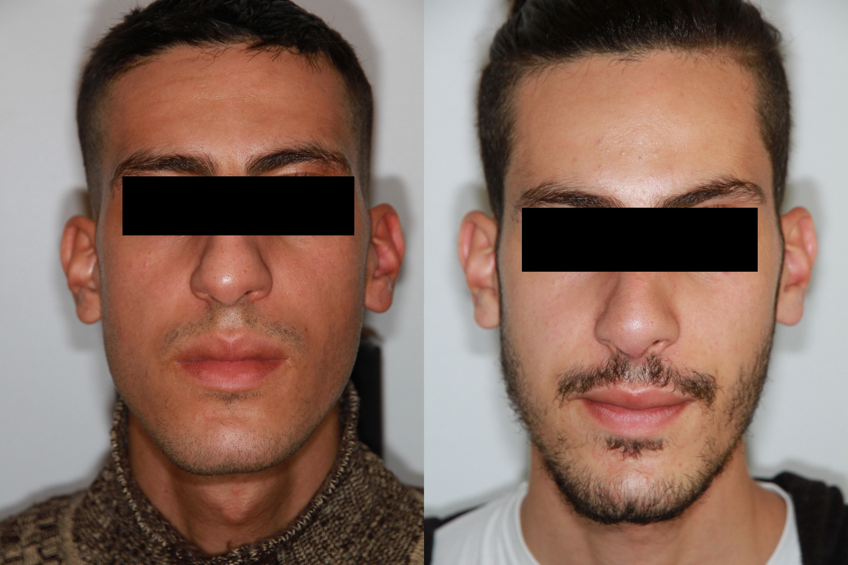 De face avant et après opération Rhinoplastie