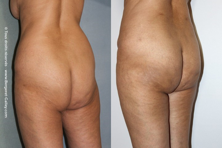 Lipofilling des fesses