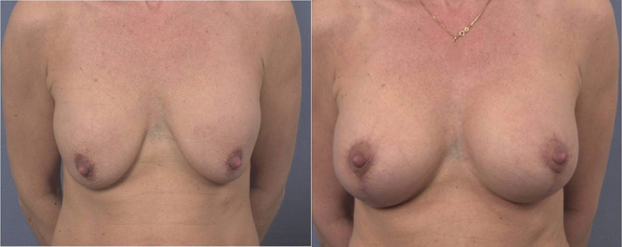 Before and after mastopexy
