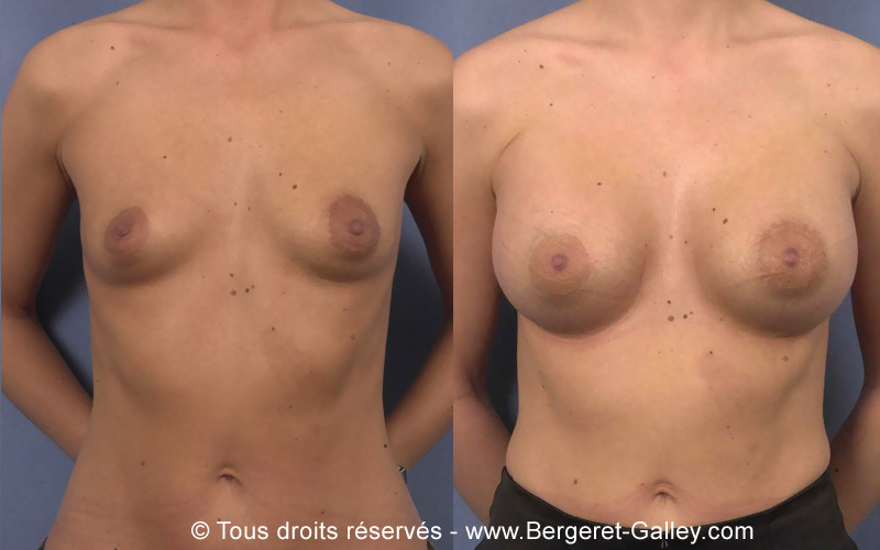 Résultat augmentation mammaire avec des prothèses 350ml de face