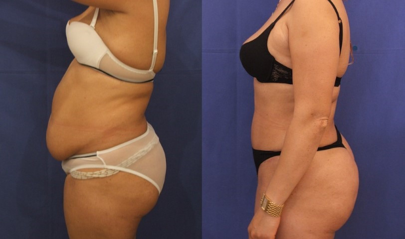 abdominoplastie