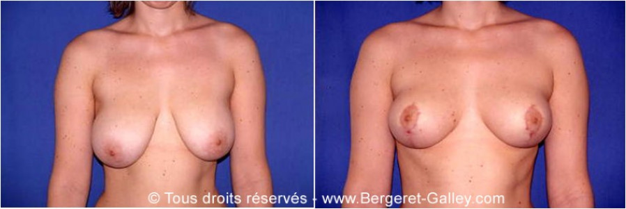 Breast reduction