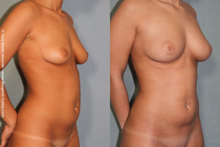 Lipofilling seins