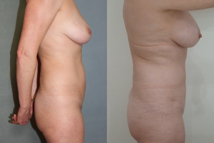 abdominoplastie