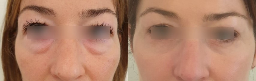 Résultat d'une blépharoplastie