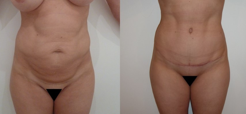 abdominoplastie