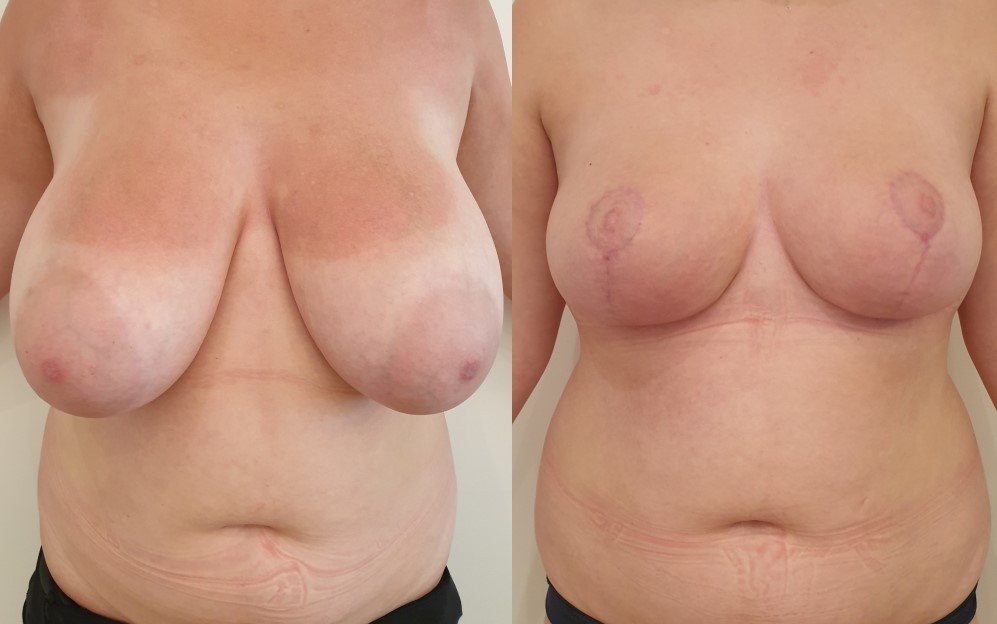 Before / After Breast reduction