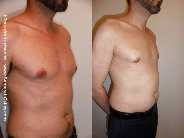 Lipoaspiration de Gynécomastie