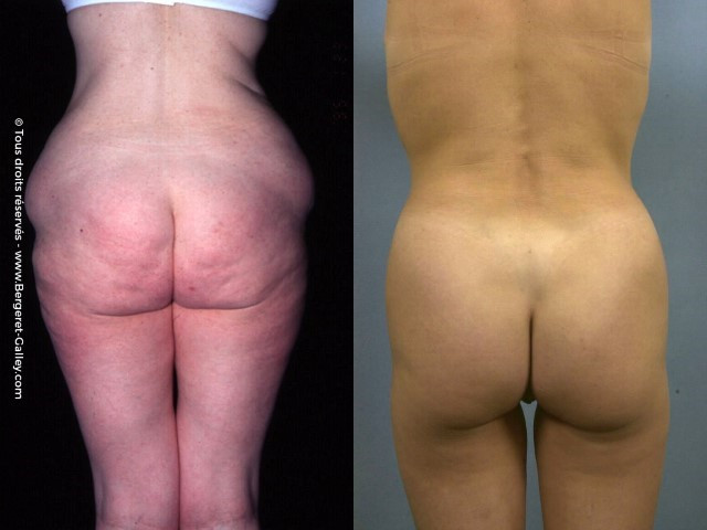Liposuccion