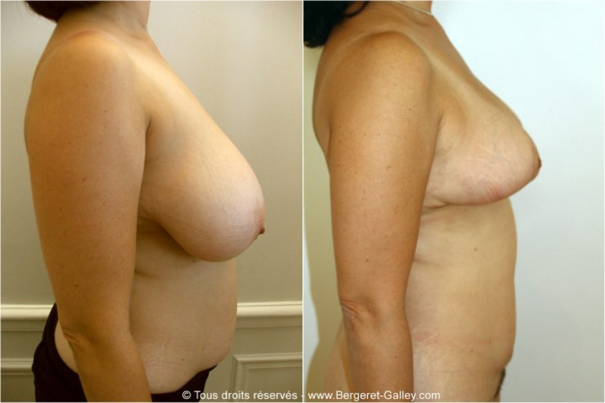 Breast reduction