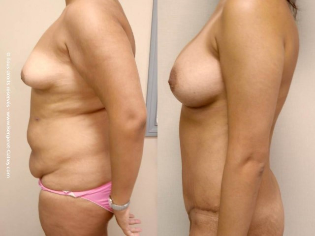 abdominoplastie chez une femme après plusieurs grossesses de profil gros tablier abdominal