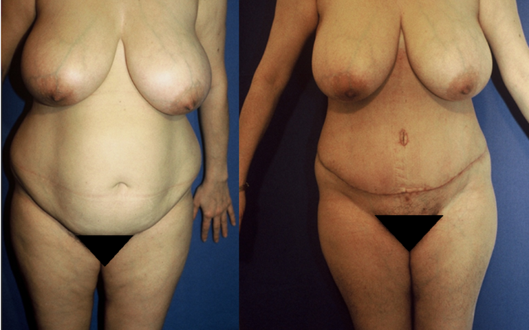 abdominoplastie