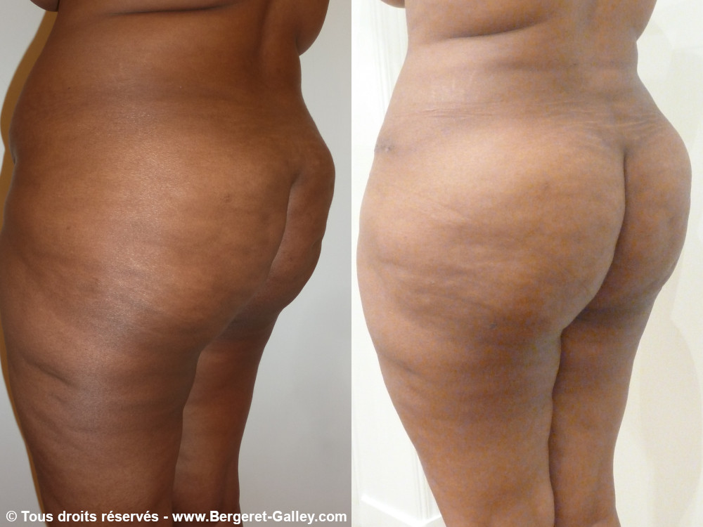 Before/After Buttocks augmentation