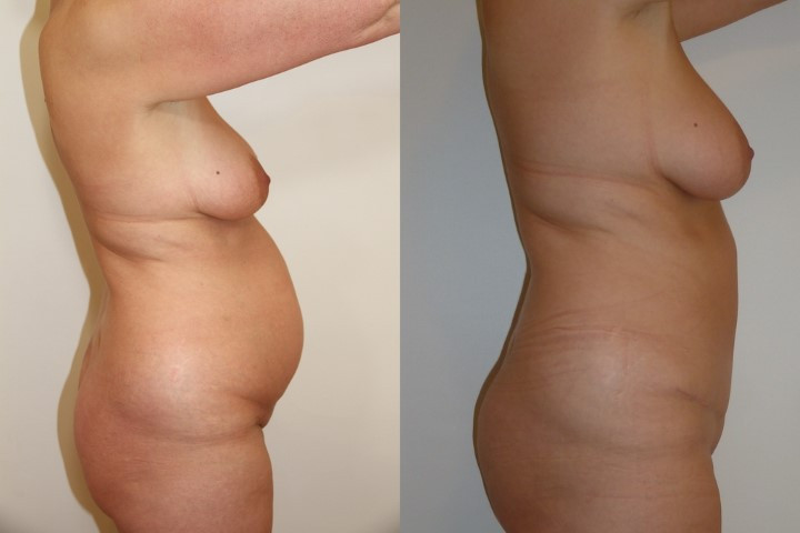 abdominoplastie